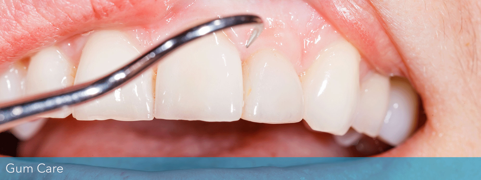 GUM TREATMENT Manchester Dental Practice